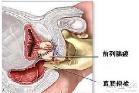 前列腺最新療法